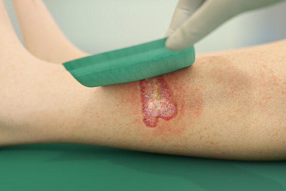 Sorbact Absorption dressing being placed over a leg wound.