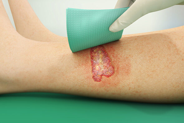 Sorbact Compress dressing being placed on a leg wound.