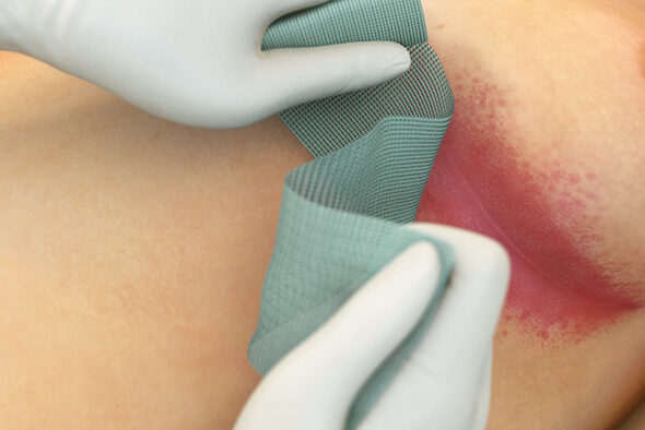 Person placing Sorbact Fungi dressing on an infected area under a breast.