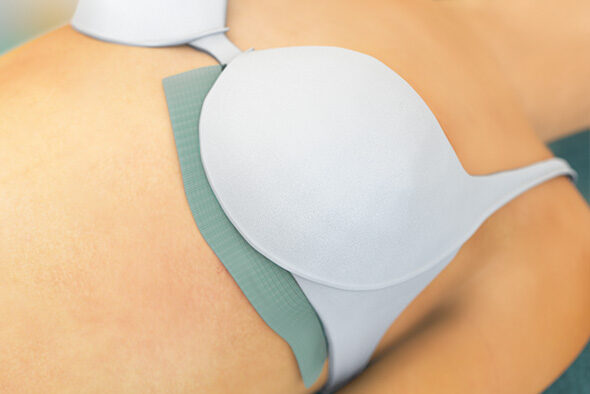 Person wearing a bra with a Sorbact Fungi dressing placed under the breast between the skin and the bra.