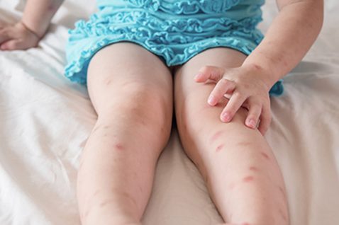 Child with insect bites on legs.