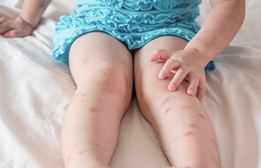Child with insect bites on legs.